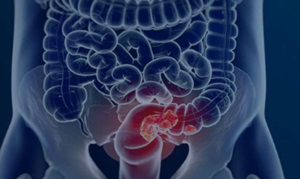 rastreamento-para-cancer-colorretal-pode-ser-implementado-no-sus